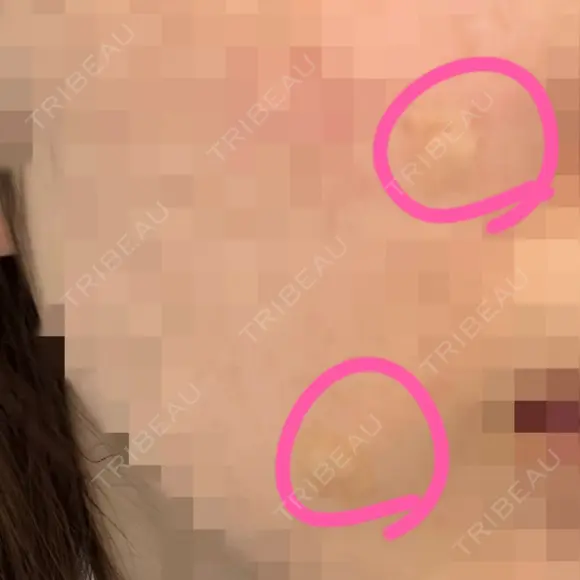 ほくろ・いぼ切除（肌） Jスキンクリニック 【J-SKIN clinic】 DAY 1 メイン用
