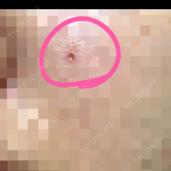 ほくろ・いぼ切除（肌） Jスキンクリニック 【J-SKIN clinic】 DAY 1 メイン用