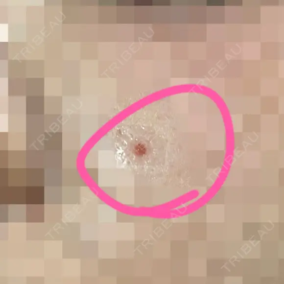 ほくろ・いぼ切除（肌） Jスキンクリニック 【J-SKIN clinic】 DAY 2 メイン用