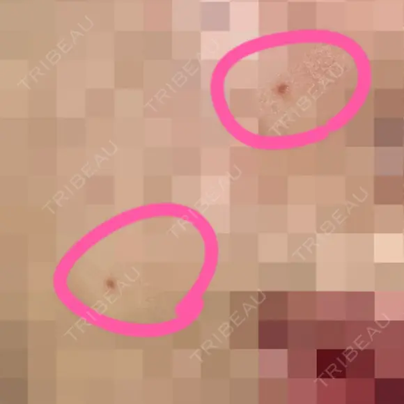 ほくろ・いぼ切除（肌） Jスキンクリニック 【J-SKIN clinic】 DAY 2 メイン用