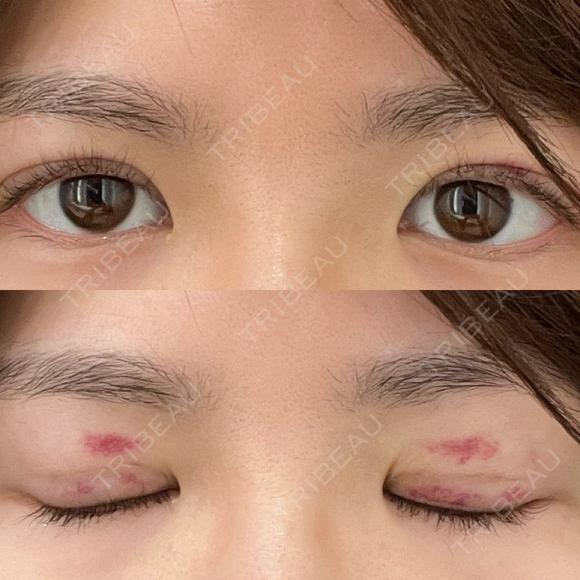 その他（目元） / 自然癒着法 LUHO（ルホ）美容外科 DAY 30 メイン用
