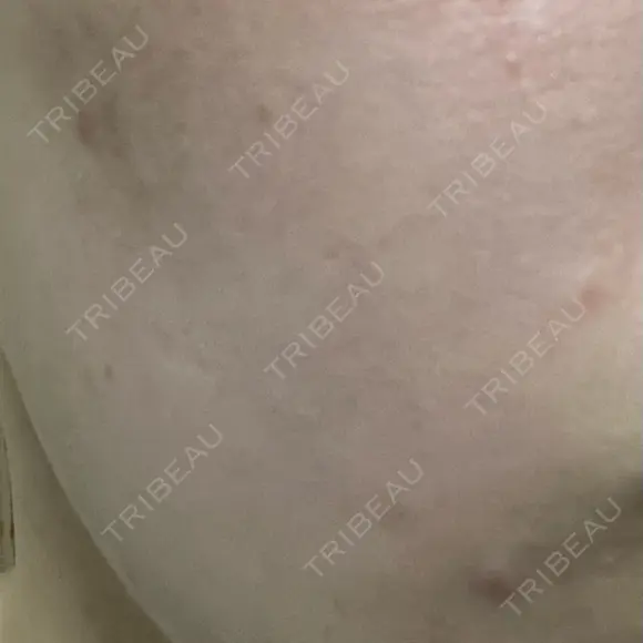 ポテンツァ 渋谷美容外科クリニック 横浜院 DAY 8 メイン用