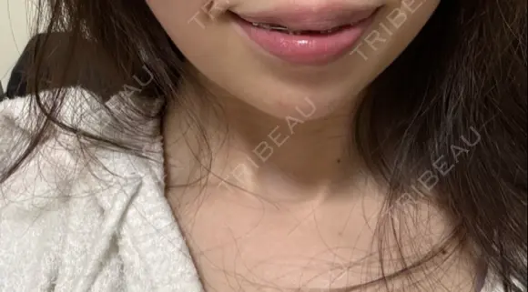 ボトックス（あご） A CLINIC（エークリニック） 新宿院 DAY 7 メイン用