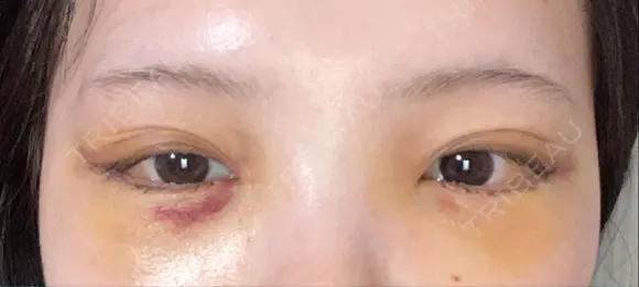 クマ治療 / 目尻切開 / タレ目形成・グラマラスライン（切開） R Beauty CLINIC 銀座院 DAY 3 メイン用