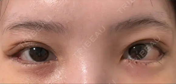 クマ治療 / 目尻切開 / タレ目形成・グラマラスライン（切開） R Beauty CLINIC 銀座院 DAY 6 メイン用