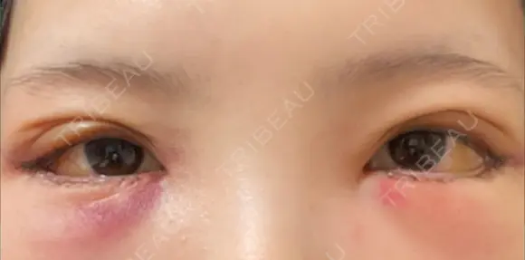 クマ治療 / 目尻切開 / タレ目形成・グラマラスライン（切開） R Beauty CLINIC 銀座院 DAY 2 メイン用