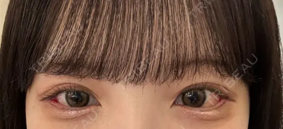 クマ治療 / 目尻切開 / タレ目形成・グラマラスライン（切開） R Beauty CLINIC 銀座院 DAY 7 メイン用