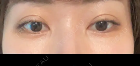 スネコス スマートスキンクリニック 神保町院 AFTER メイン用