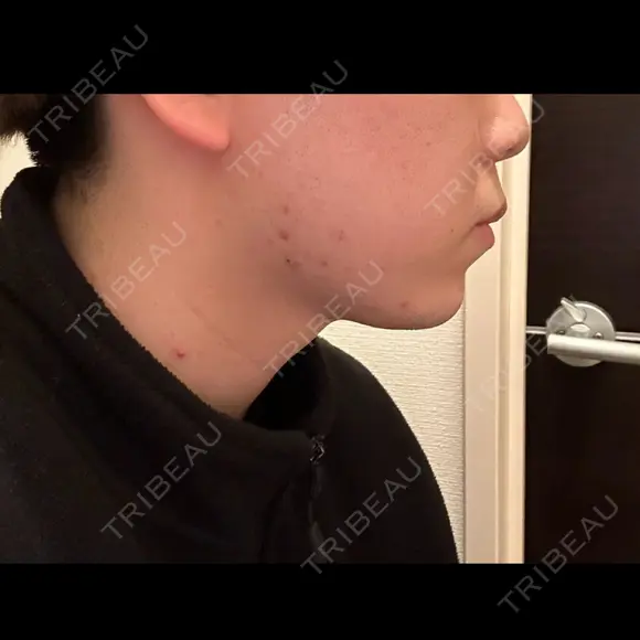 ヒアルロン酸注入（あご） ヴェリテクリニック 大阪院 AFTER メイン用