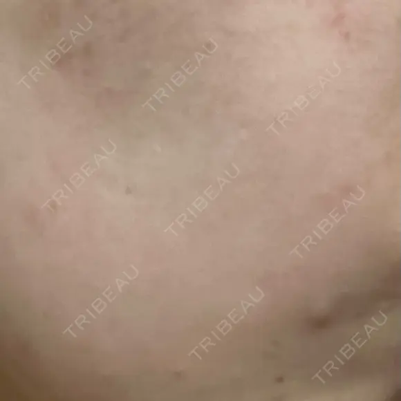 ポテンツァ 渋谷美容外科クリニック 横浜院 DAY 10 メイン用