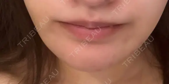 骨切り（あご） / 脂肪吸引（顔） / ジョールファット除去 銀座マイアミ美容外科 AFTER メイン用