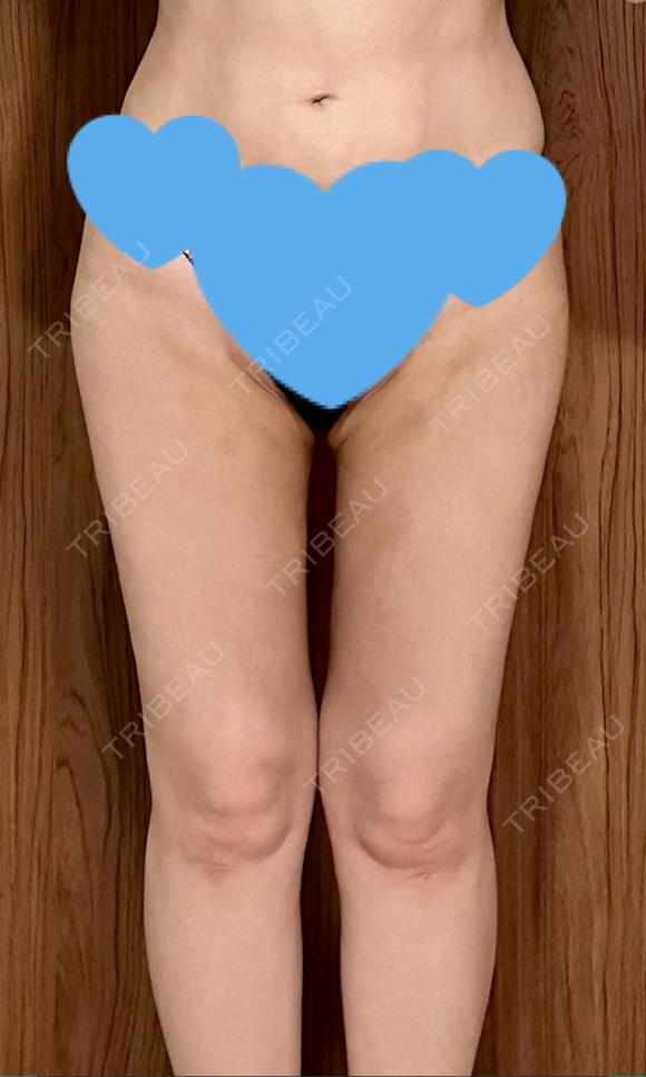 脂肪吸引（顔） / 脂肪吸引（脚） / 脂肪吸引（お尻） Mods Clinic（モッズクリニック） 福岡院 DAY 93 メイン用