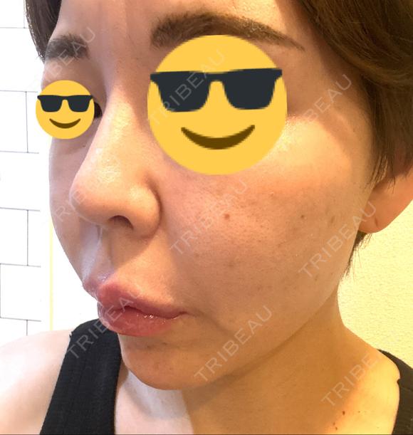 ヒアルロン酸注入（鼻） プリモ麻布十番クリニック DAY 9 メイン用