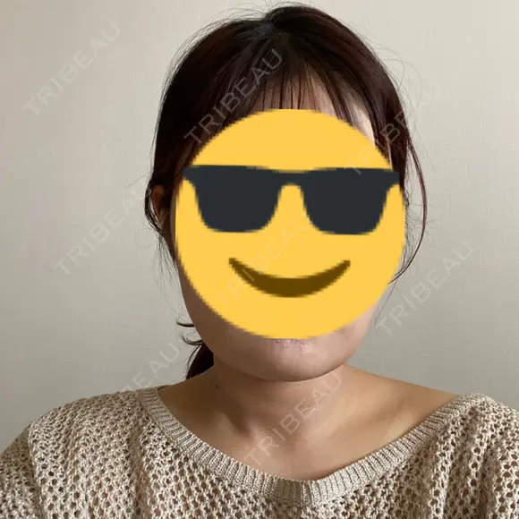 脂肪吸引（顔） / ボトックス（エラ・小顔） ネビュラクリニック 京都院 DAY 22 メイン用