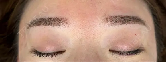 アートメイク（眉） 東京中央クリニック DAY 0 メイン用