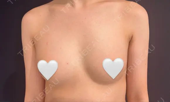豊胸（脂肪注入） S.T styleクリニック DAY 7 メイン用