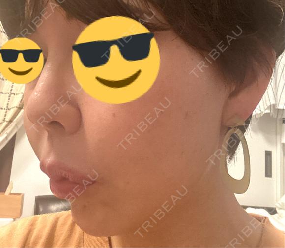 ヒアルロン酸注入（鼻） プリモ麻布十番クリニック AFTER メイン用
