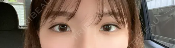 二重埋没 R Beauty CLINIC 名古屋院 DAY 2 メイン用