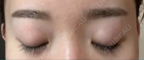 アートメイク（眉） 東京中央クリニック DAY 2 メイン用