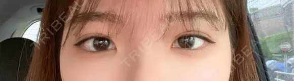 二重埋没 R Beauty CLINIC 名古屋院 DAY 3 メイン用