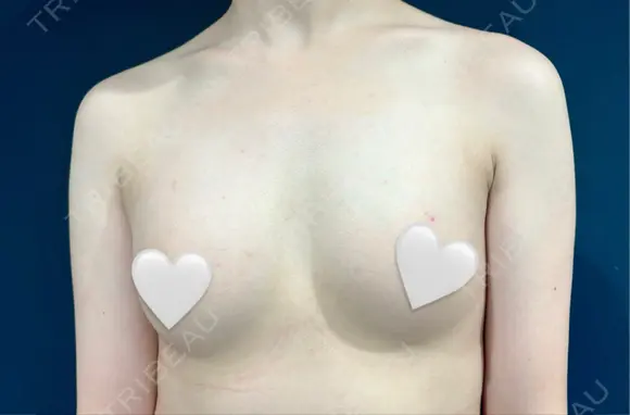 豊胸（脂肪注入） S.T styleクリニック DAY 37 メイン用