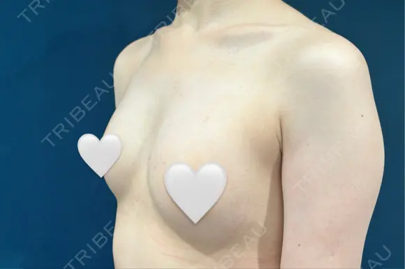 豊胸（脂肪注入） S.T styleクリニック DAY 37 メイン用