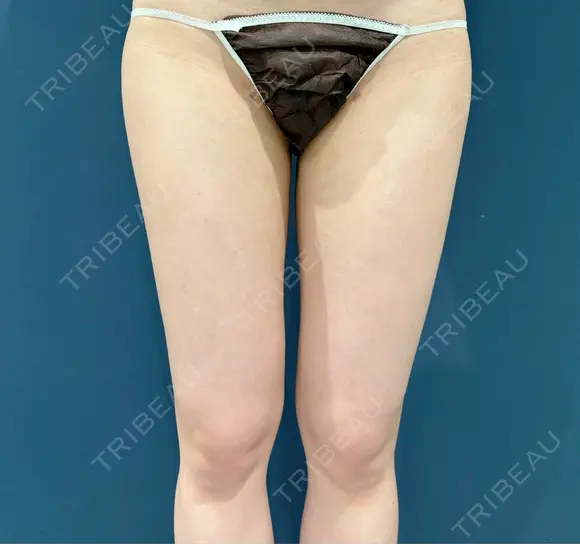 豊胸（脂肪注入） S.T styleクリニック DAY 37 メイン用