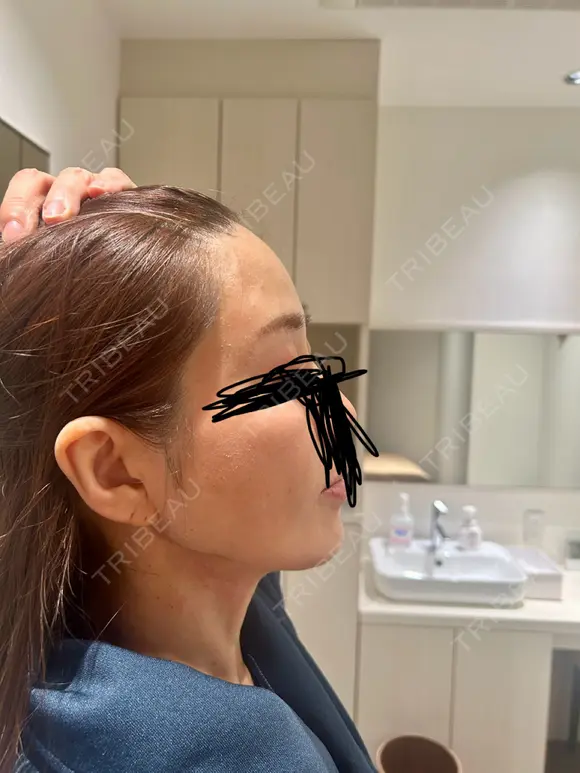 脂肪注入（額） Mods Clinic（モッズクリニック） 福岡院 DAY 29 メイン用