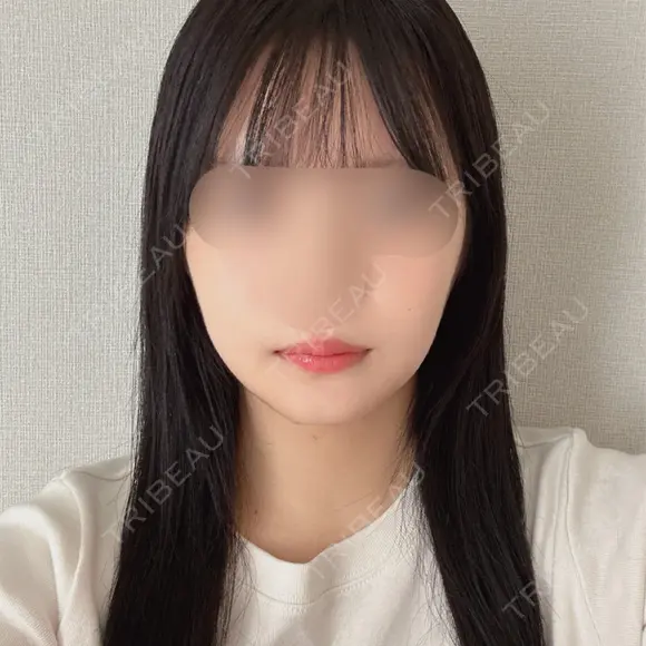 骨切り（あご） / 骨削り（エラ） / 骨削り（頬） / バッカルファット除去 / 脂肪吸引（顔） バタン美容整形外科 DAY 94 メイン用