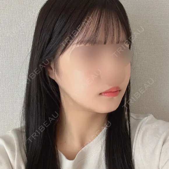 骨切り（あご） / 骨削り（エラ） / 骨削り（頬） / バッカルファット除去 / 脂肪吸引（顔） バタン美容整形外科 DAY 94 メイン用