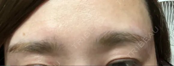 アートメイク除去・修正 LEAGRANT CLINIC 中目黒 AFTER メイン用