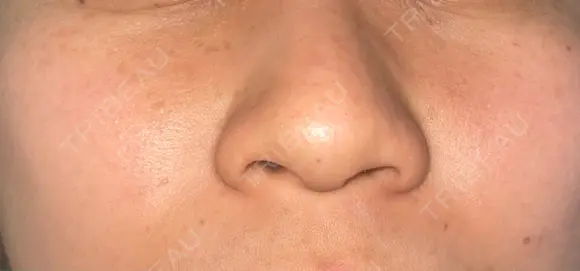 ルメッカ Belle Via Skin Clinic AFTER メイン用