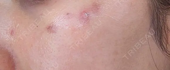 ピコスポット G MEDICAL ART クリニック 新宿院 DAY 2 メイン用