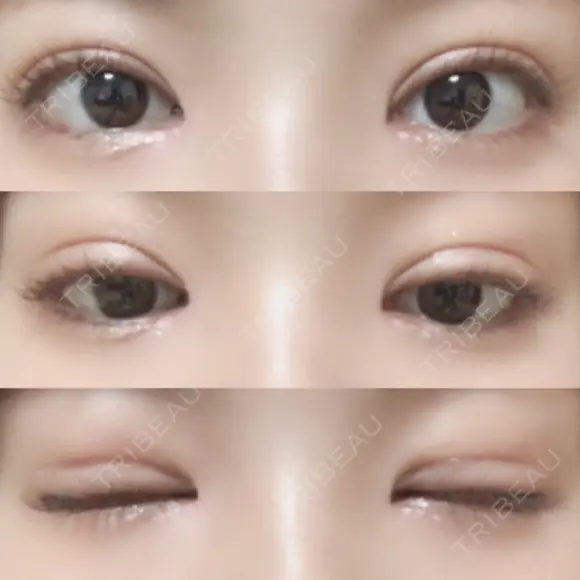 二重切開 / 目頭切開 / 眼瞼下垂（切開） / その他（目元） / 上まぶたの脂肪取り レアート整形外科 DAY 25 メイン用