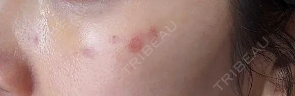 ピコスポット G MEDICAL ART クリニック 新宿院 DAY 3 メイン用