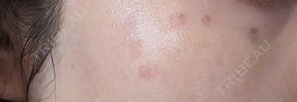 ピコスポット G MEDICAL ART クリニック 新宿院 DAY 3 メイン用