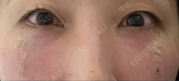 クマ治療 / 脂肪注入（目の下） 湘南美容クリニック 千葉センシティ院 DAY 0 メイン用