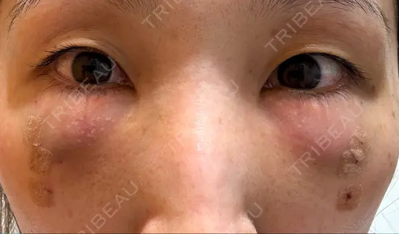 クマ治療 / 脂肪注入（目の下） 湘南美容クリニック 千葉センシティ院 DAY 1 メイン用