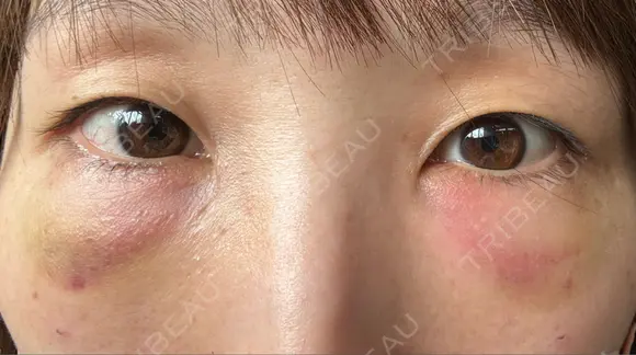 クマ治療 / 脂肪注入（目の下） 湘南美容クリニック 千葉センシティ院 DAY 2 メイン用