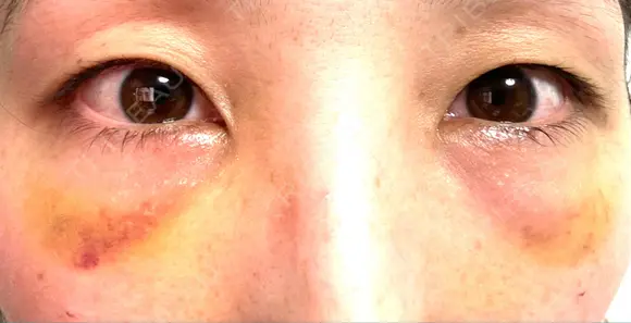 クマ治療 / 脂肪注入（目の下） 湘南美容クリニック 千葉センシティ院 DAY 4 メイン用