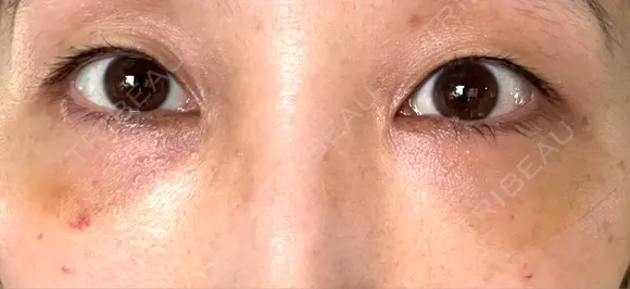 クマ治療 / 脂肪注入（目の下） 湘南美容クリニック 千葉センシティ院 DAY 6 メイン用