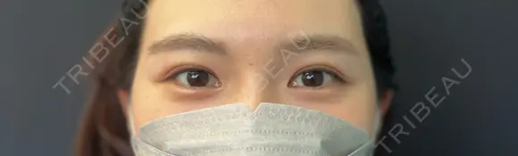 二重埋没 湘南美容クリニック 千葉センシティ院 AFTER メイン用