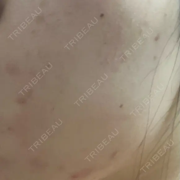 ポテンツァ 渋谷美容外科クリニック 横浜院 DAY 15 メイン用