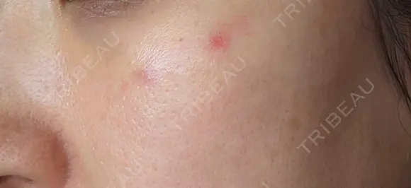 ピコスポット G MEDICAL ART クリニック 新宿院 DAY 4 メイン用