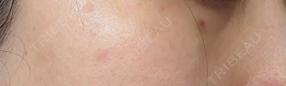 ピコスポット G MEDICAL ART クリニック 新宿院 DAY 4 メイン用