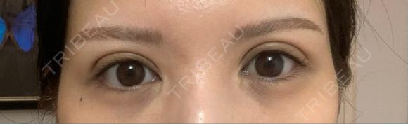 二重切開 / 目頭切開 / 眼瞼下垂（切開） / 上まぶたの脂肪取り エターナル美容クリニック DAY 149 メイン用