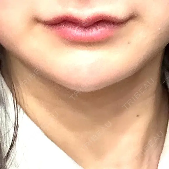 ヒアルロン酸注入（あご） 銀座美容外科クリニック 新宿院 AFTER メイン用