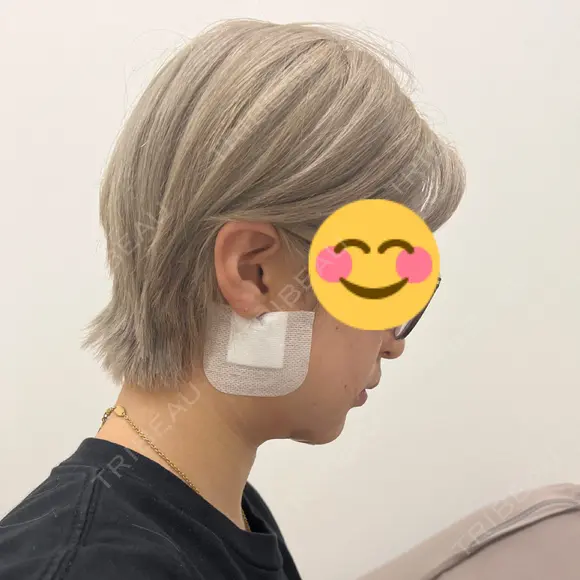 脂肪吸引（顔） お茶の水美容形成クリニック DAY 1 メイン用