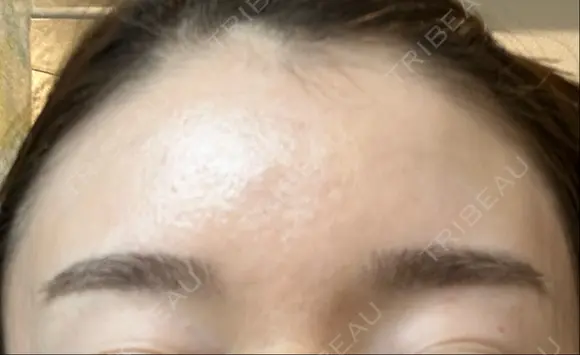 アートメイク（眉） 東京中央クリニック AFTER メイン用