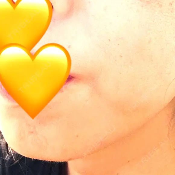 糸リフト アリエル美容クリニック 郡山院 DAY 20 メイン用